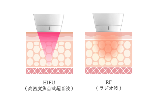 HIFU(高密度焦点式超音波)｜RF(ラジオ波)