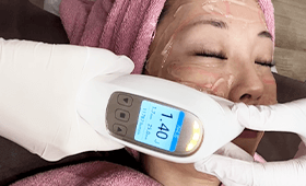 ハイフの施術の流れ 05